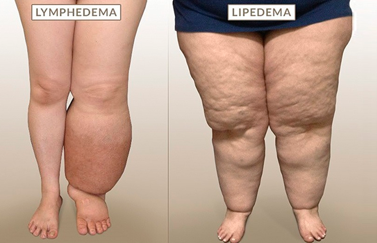 Diferenças entre Lipedema e Linfedema