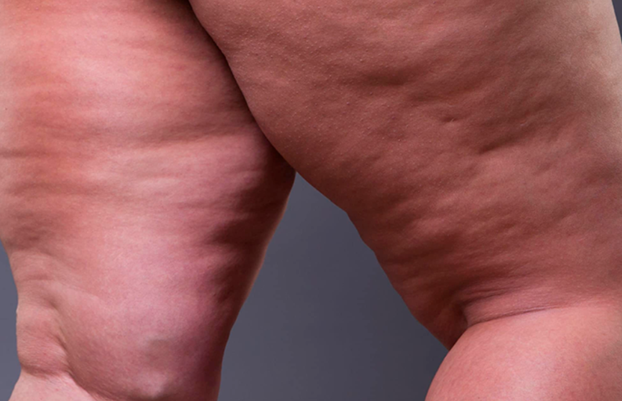 Entendendo o Lipedema: Sintomas, Diagnóstico e Tratamento